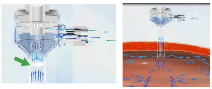 一次性使用腹部穿刺器注冊審查指導(dǎo)原則(2021年第103號(hào))(圖2) 一次性使用腹部穿刺器注冊審查指導(dǎo)原則(2021年第103號(hào))(圖2)
