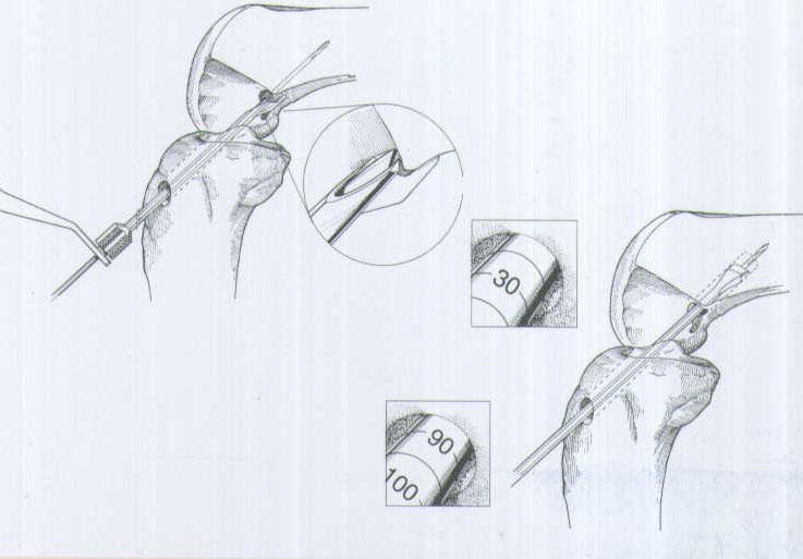 肌腱韌帶固定系統(tǒng)注冊技術(shù)審查指導(dǎo)原則(2020年第36號)(圖1) 肌腱韌帶固定系統(tǒng)注冊技術(shù)審查指導(dǎo)原則(2020年第36號)(圖1)